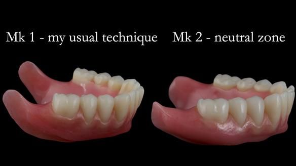 Replacing Madeline’s Complete denture FULL PROTOCOL