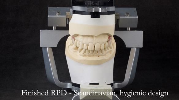 Solving Sue's failed implants with metal based RPD - full protocol Newsletter 43