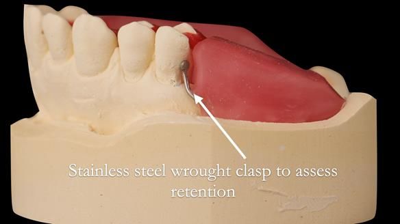 Solving Sue's failed implants with metal based RPD - full protocol Newsletter 43