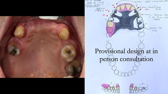 Newsletter 71 Jean’s Class I Mod III RPD: See my mistakes Fractured Mk1 to a Stronger Mk2 RPD (4 years on)