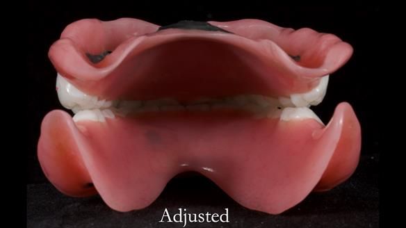 Newsletter 65 Marisa Provision of Complete Dentures on badly placed implants