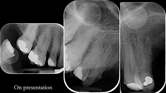 How Keith’s combat denture transformed his life – Newsletter 73