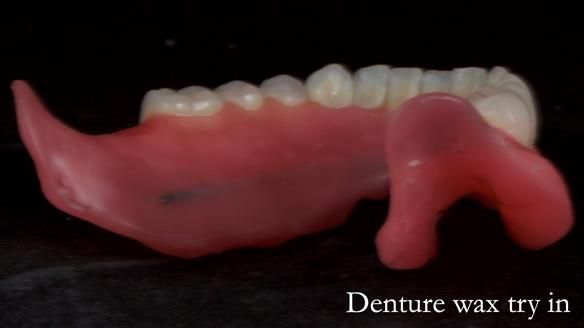 Newsletter 70 Complete Denture Treatment for Kate: A Case Study on Natural-Looking Dentures and Implant-Supported Overdentures