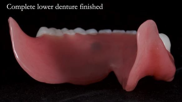 Newsletter 65 Marisa Provision of Complete Dentures on badly placed implants