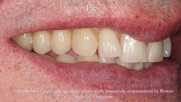 Newsletter 74: Ken’s Case Study Complete Dentures - Life Like and Age Appropriate