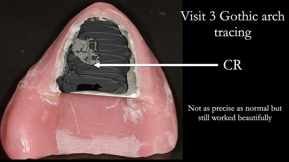 Newsletter 74: Ken’s Case Study Complete Dentures - Life Like and Age Appropriate