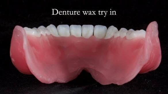 Newsletter 65 Marisa Provision of Complete Dentures on badly placed implants