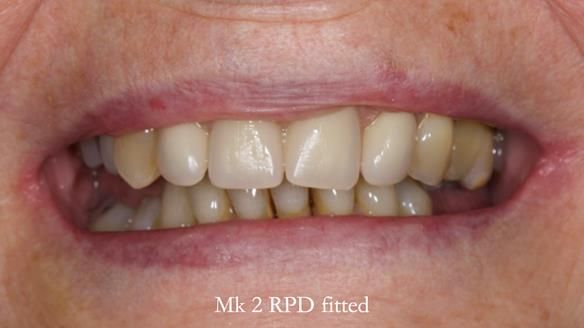 Newsletter 71 Jean’s Class I Mod III RPD: See my mistakes Fractured Mk1 to a Stronger Mk2 RPD (4 years on)