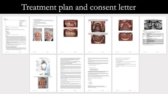 Eileen's transformation with upper and lower RPDs of Scandinavian hygienic design FULL PROTOCOL