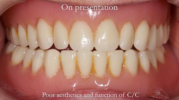 Newsletter 48 Mavis's Complete denture FULL PROTOCOL