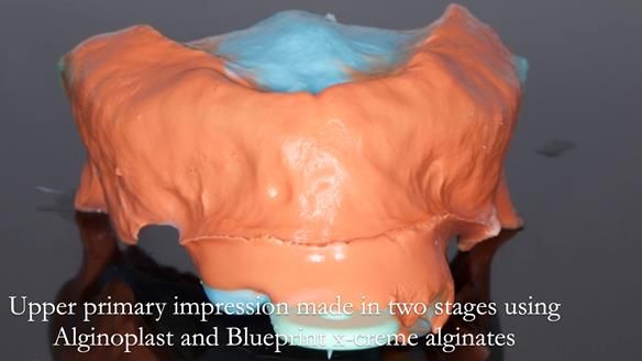 Replacing Madeline’s Complete denture FULL PROTOCOL