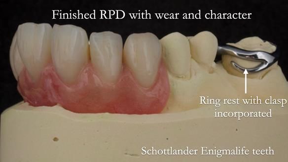 Eileen's transformation with upper and lower RPDs of Scandinavian hygienic design FULL PROTOCOL