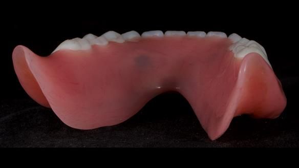 Newsletter 65 Marisa Provision of Complete Dentures on badly placed implants