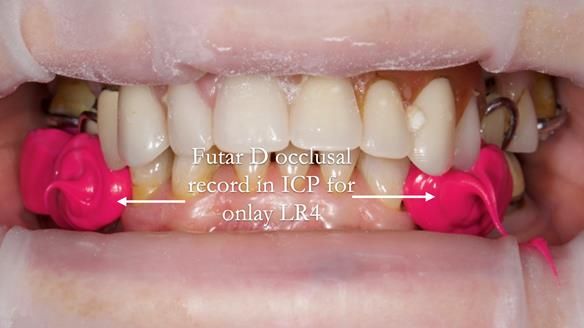 Eileen's transformation with upper and lower RPDs of Scandinavian hygienic design FULL PROTOCOL