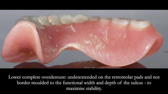 Newsletter 74: Ken’s Case Study Complete Dentures - Life Like and Age Appropriate