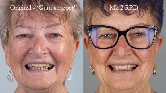 Newsletter 71 Jean’s Class I Mod III RPD: See my mistakes Fractured Mk1 to a Stronger Mk2 RPD (4 years on)