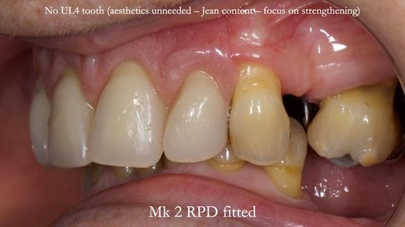 Newsletter 71 Jean’s Class I Mod III RPD: See my mistakes Fractured Mk1 to a Stronger Mk2 RPD (4 years on)