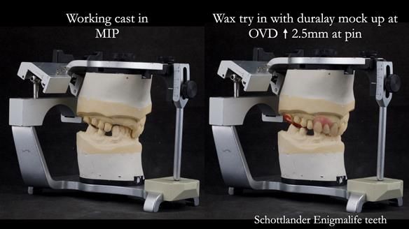 Read Newsletter 67 - Brian's COMBAT DENTURE Case Study