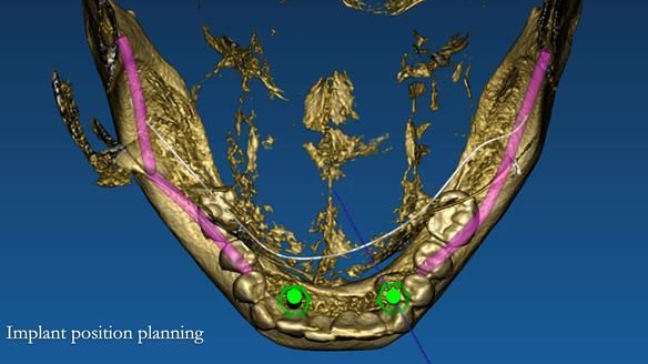 Newsletter 70 Complete Denture Treatment for Kate: A Case Study on Natural-Looking Dentures and Implant-Supported Overdentures