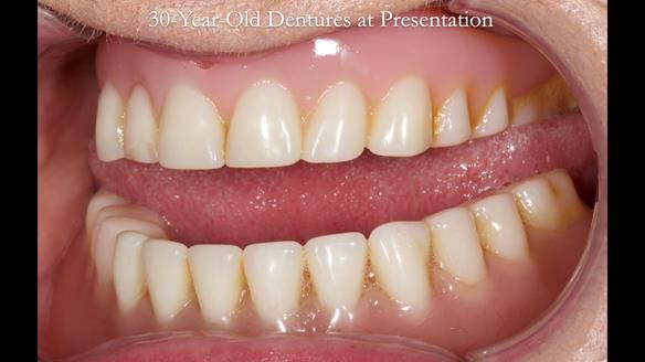 Newsletter 68 Restoring Jan’s Smile: Complete Dentures Inspired by Her Daughter’s Teeth - Post Mouth Surgery