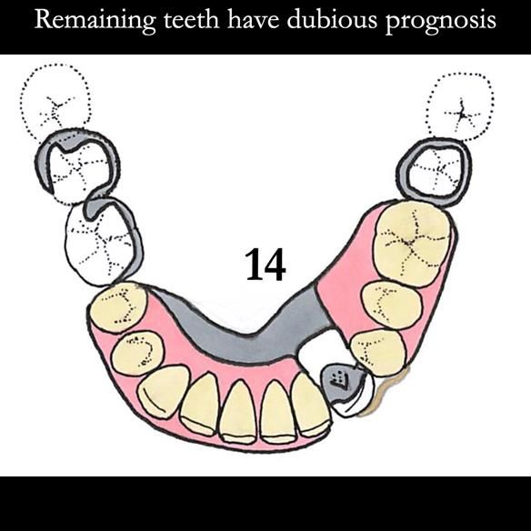 Universal Scandinavian partial denture designs