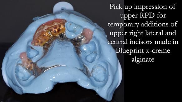 Eileen's transformation with upper and lower RPDs of Scandinavian hygienic design FULL PROTOCOL