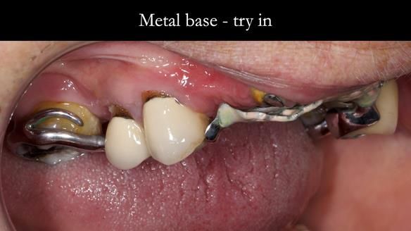 Eileen's transformation with upper and lower RPDs of Scandinavian hygienic design FULL PROTOCOL