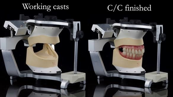 Replacing Madeline’s Complete denture FULL PROTOCOL