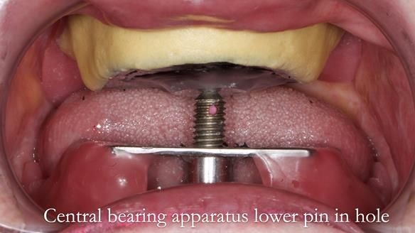 Replacing Madeline’s Complete denture FULL PROTOCOL