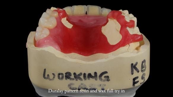 How Keith’s combat denture transformed his life – Newsletter 73