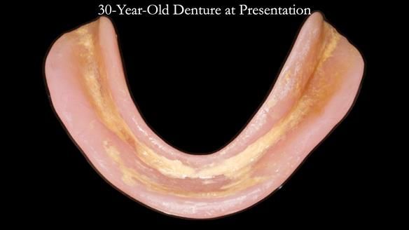 Newsletter 68 Restoring Jan’s Smile: Complete Dentures Inspired by Her Daughter’s Teeth - Post Mouth Surgery