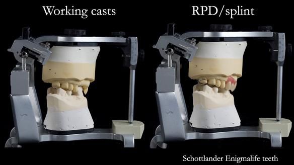 Read Newsletter 67 - Brian's COMBAT DENTURE Case Study