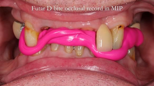 Managing Edgar “THE SCEPTIC” with an RPD/Splint FULL CASE