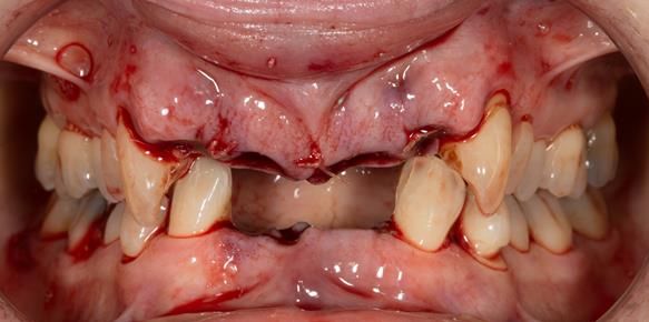 Figure 29 Extraction sites - sutures on the upper