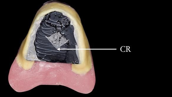 Replacing Madeline’s Complete denture FULL PROTOCOL