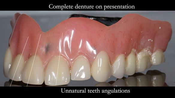 Newsletter 74: Ken’s Case Study Complete Dentures - Life Like and Age Appropriate