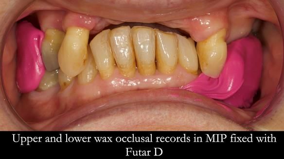 Newsletter 71 Jean’s Class I Mod III RPD: See my mistakes Fractured Mk1 to a Stronger Mk2 RPD (4 years on)