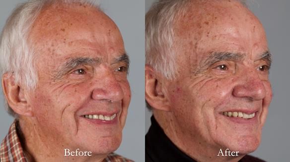 Newsletter 74: Ken’s Case Study Complete Dentures - Life Like and Age Appropriate