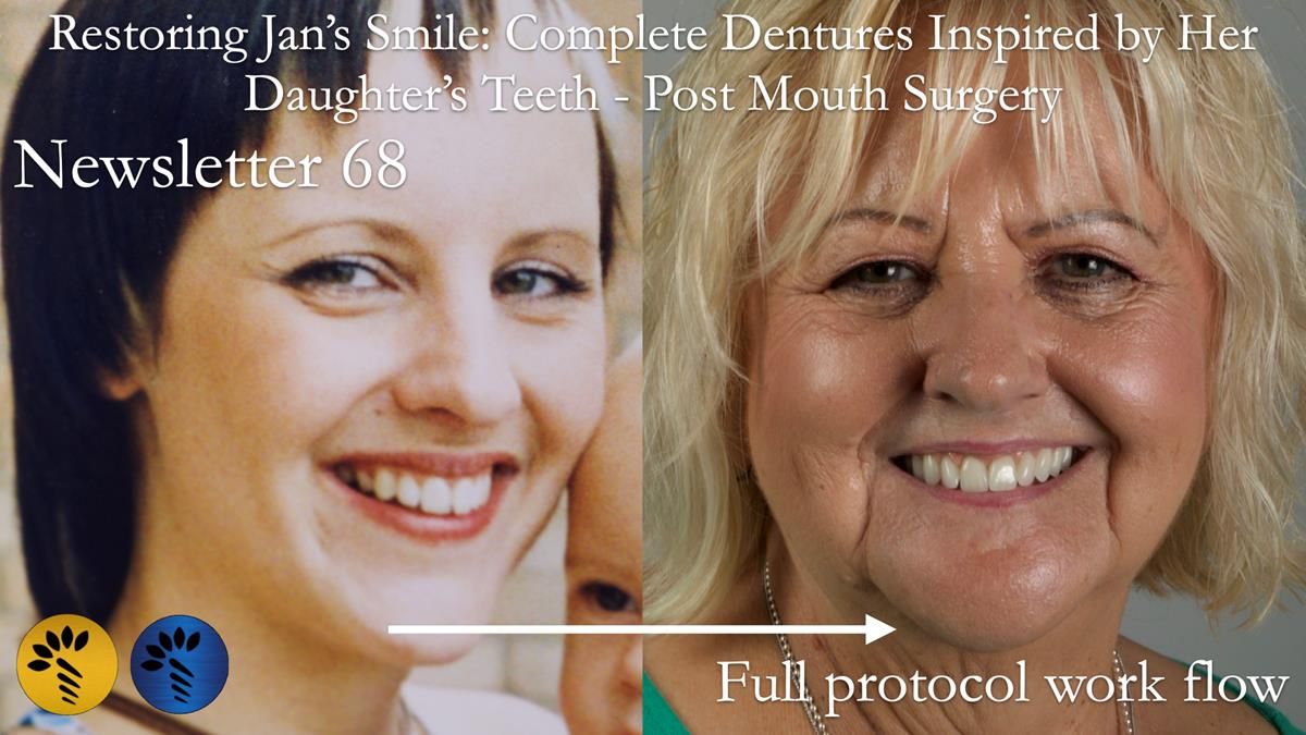 Newsletter 68 Restoring Jan’s Smile: Complete Dentures Inspired by Her Daughter’s Teeth - Post Mouth Surgery