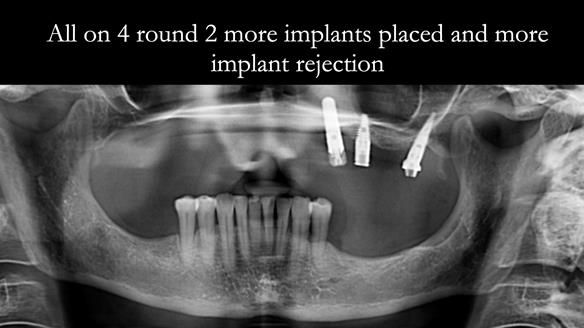 Solving Linda’s Failed “All on 4” implant bridges - full protocol Newsletter 42