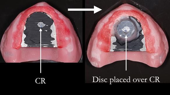 Newsletter 48 Mavis's Complete denture FULL PROTOCOL