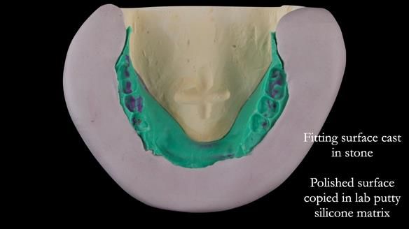 Replacing Madeline’s Complete denture FULL PROTOCOL