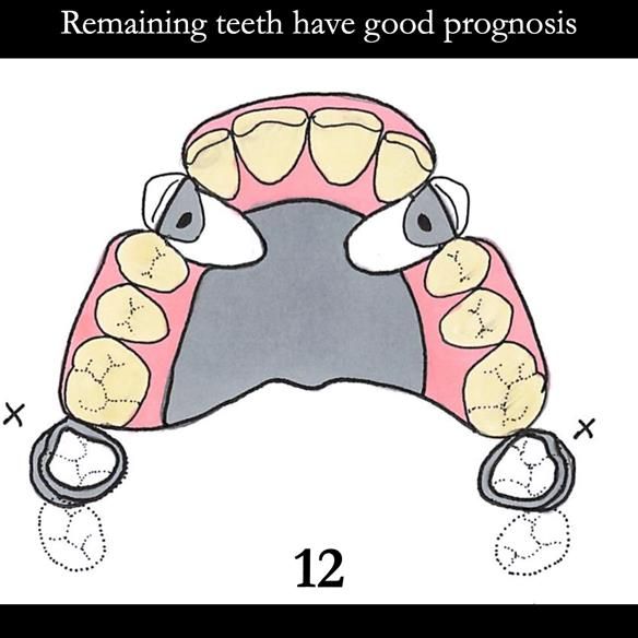 Universal Scandinavian partial denture designs