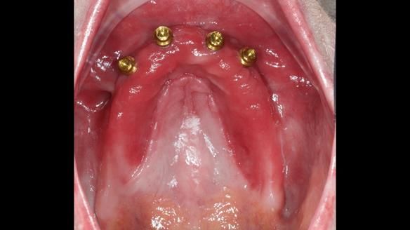 Newsletter 65 Marisa Provision of Complete Dentures on badly placed implants