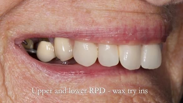 Eileen's transformation with upper and lower RPDs of Scandinavian hygienic design FULL PROTOCOL