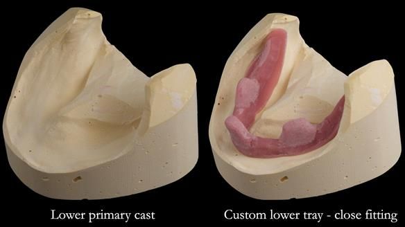 Replacing Madeline’s Complete denture FULL PROTOCOL