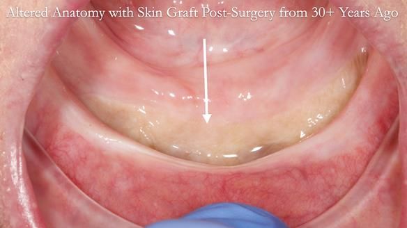 Newsletter 68 Restoring Jan’s Smile: Complete Dentures Inspired by Her Daughter’s Teeth - Post Mouth Surgery