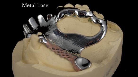 How Keith’s combat denture transformed his life – Newsletter 73