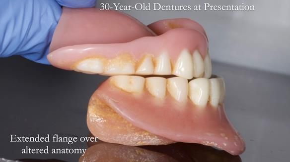 Newsletter 68 Restoring Jan’s Smile: Complete Dentures Inspired by Her Daughter’s Teeth - Post Mouth Surgery