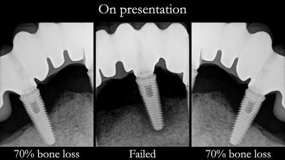 Newsletter 49 Managing Estelle’s failing implants with dentures FULL PROTOCOL